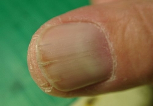 親指の爪